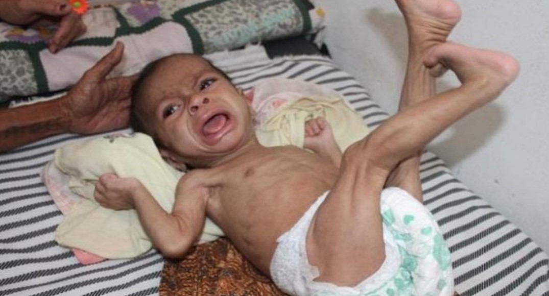 Fomula Ready to Use Therapeutic Bisa Atasi Balita Wasting